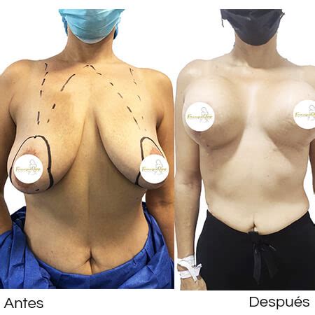Antes y después mastopexia de Francisco Reyes Montero