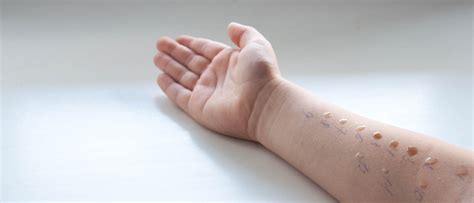 Skin Prick Test London Allergy Care