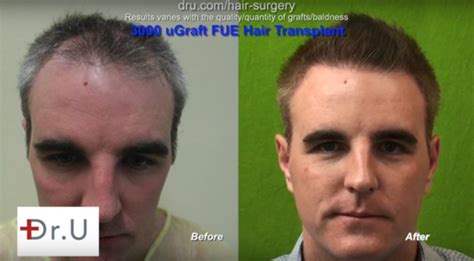 Los Angeles Fue Hair Transplant Follicular Unit Extraction