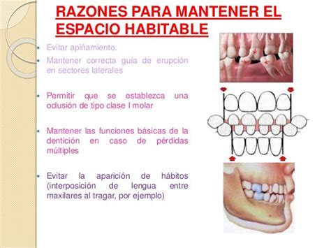 Mantenedores De Espacio Odontopediatria Ppt