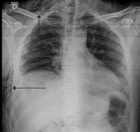 Emphysema Chest X Ray