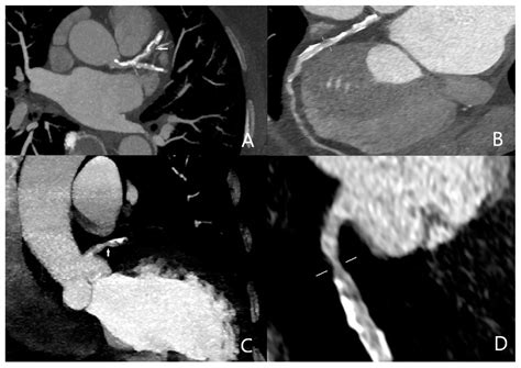 Diagnostics Free Full Text Quadruple Rule Out Computed Tomography