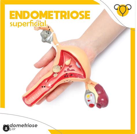 Endometriose Superficial