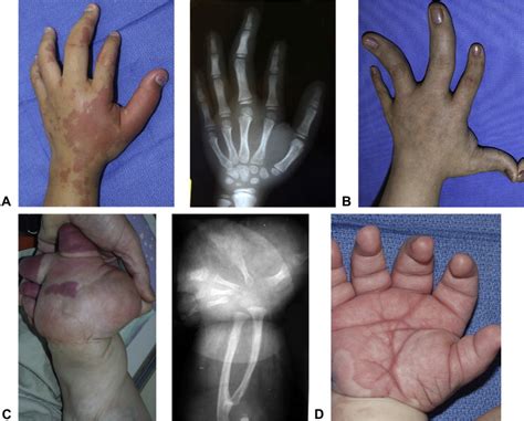 Cloves Syndrome Journal Of Hand Surgery