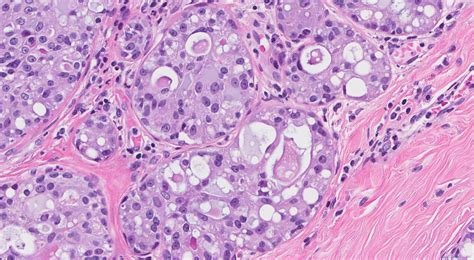 Secretory Carcinoma Of The Breast Ottawa Atlas Of Pathology