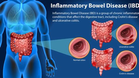 Bowel Disorders And Symptoms