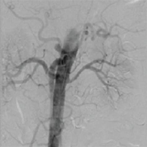 Case 1— A Ct Renal Angiogram Showing Right Renal Artery Before