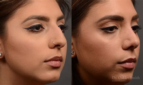 Top Ontario Rhinoplasty Surgeon Dr Oakley Smith