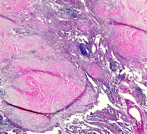 Silicosis Histology