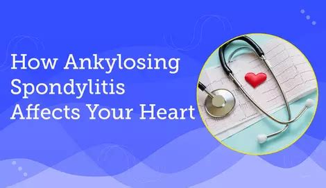 DISH vs. Ankylosing Spondylitis: What To Know | MySpondylitisTeam