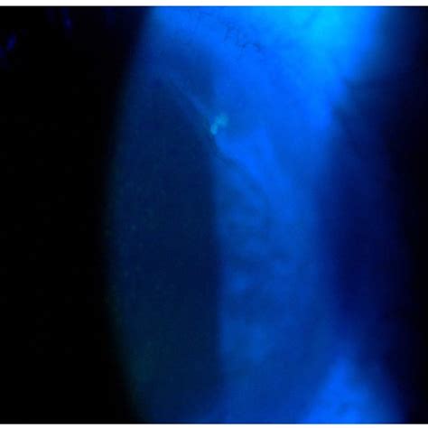 Presence Of A Fluorescein Positive Microdendrite In The Supero Nasal Download Scientific