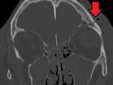 Basilar skull fracture - WikEM