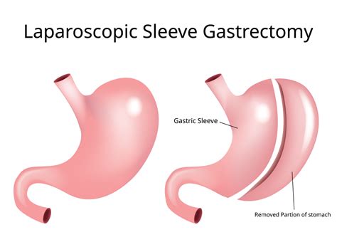 SLEEVE GASTRECTOMY SURGERY COST IN INDIA - HealSpoc Healthcare Services