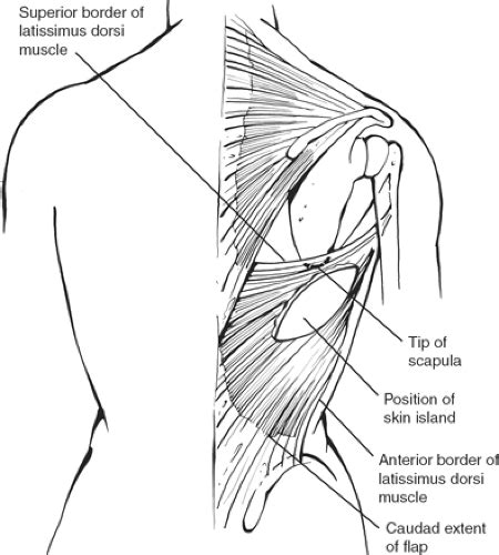 Soft Tissue Reconstruction With Flap Techniques Basicmedical Key