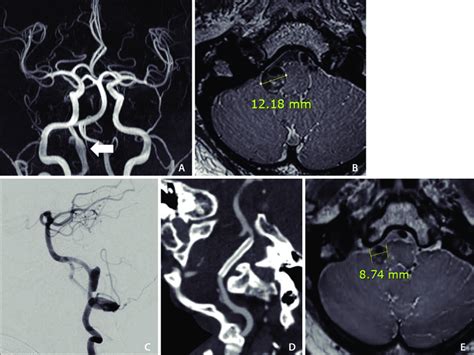 A Case Of Right Vertebral Artery Dissecting Aneurysm Vada With Tapia Download Scientific