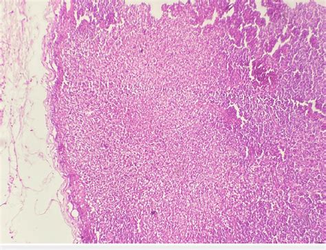 Low Power View Hematoxylin And Eosin X100 Of The Lymph Node