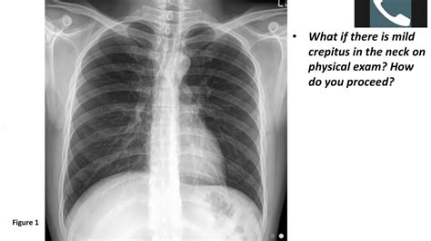 Thoracic Surgery Didactics—esophageal Perforation Youtube