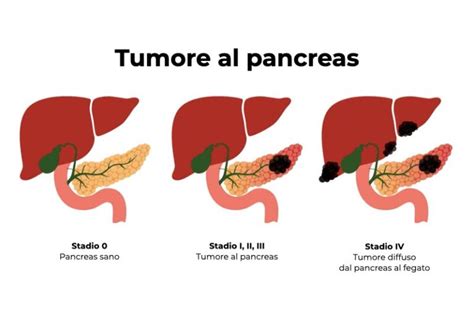 Tumore Del Pancreas Cause Sintomi E Trattamenti Innovativi