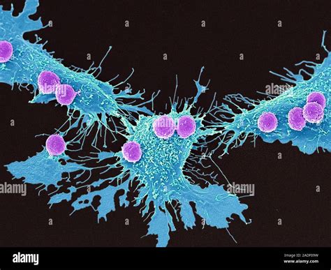 T Lymphocytes And Cancer Cells Coloured Scanning Electron Micrograph