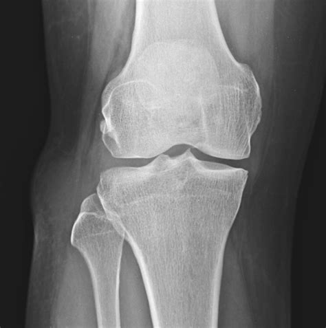 Ganglion Cyst Knee Image