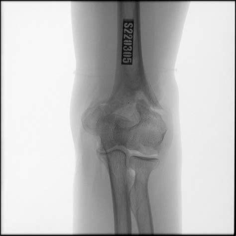 Fracture Of Distal Humerus Left