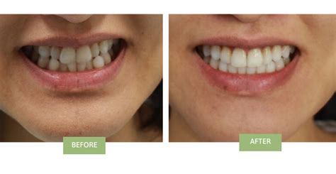 Invisalign For Crowded Teeth Can Invisalign Fix Crowding