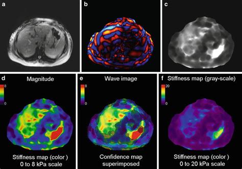 Liver Magnetic Resonance Elastography Technique | Radiology Key