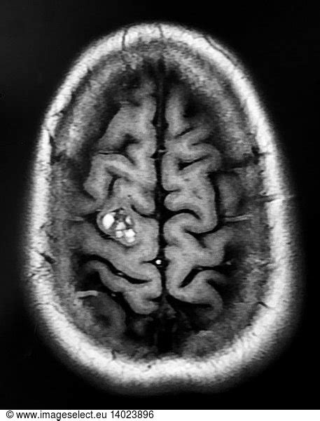 Cavernous Malformation Frontal Lobe Mri Cavernous Malformation Frontal