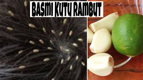 Cara Menghilangkan Kutu Rambut Dan Telur Nya Dengan Cepat Youtube