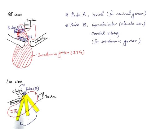 Radiofrequency Ablation For Intrathoracic Goiter On Behance