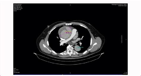 Pre-OP CT-Scan: Axial: Ascending and descending aorta. | Download ...