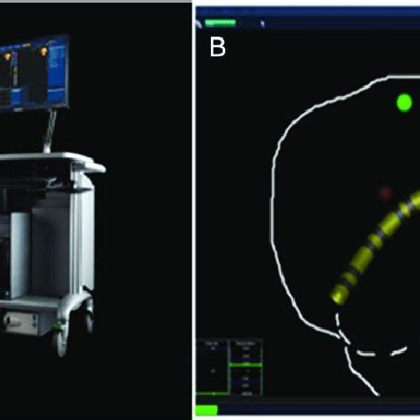 Electrophysiological Study And Mapping Was Conducted Using The NAVX