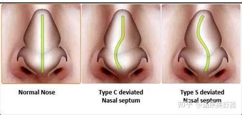 鼻中隔偏曲 在整形医院解决的办法（vs 耳鼻喉医院） 知乎