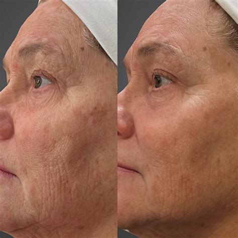 Broadband Light Therapy Clarity Medical Aesthetics