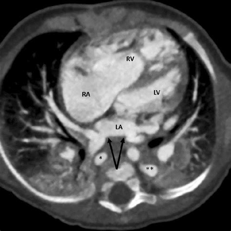 Two-month-old boy with d-TGA status post arterial switch operation. a ...