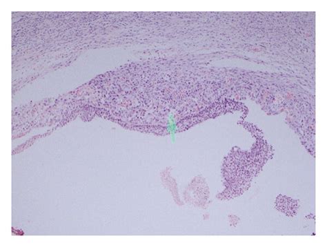 Right Ovary Histology Ovarian Tissue Comprises Multiple Ovarian