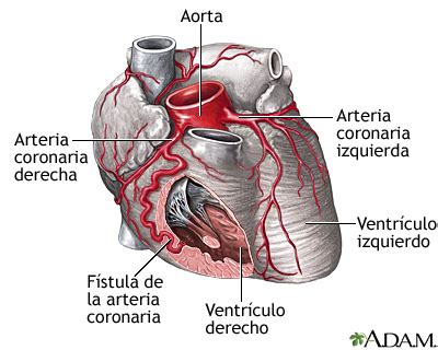 Fístula de la arteria coronaria MedlinePlus enciclopedia médica