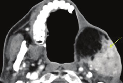 Tumor Recurrence At Flap Margin Expansile Enhancing Soft Tissue