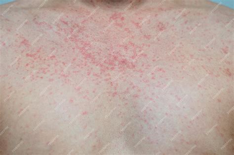 471 Images Of Viral Exanthem Pics Myweb