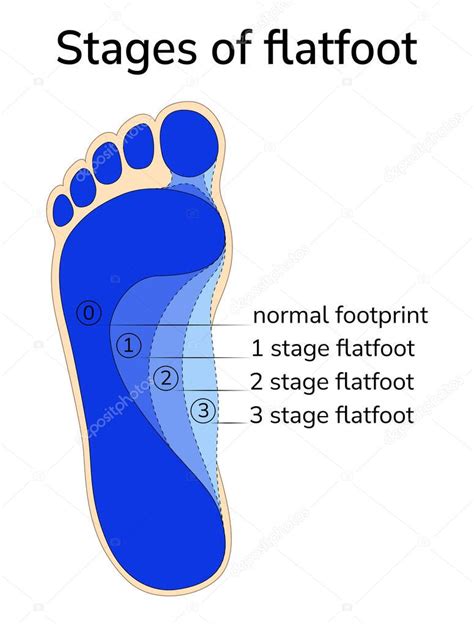 Ilustración De La Etapa De Progresión De Los Pies Planos Diferentes Etapas De Los Pies Planos