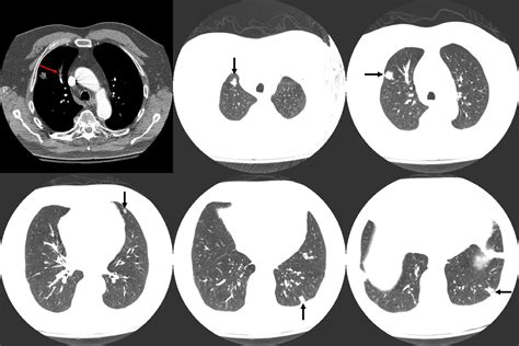 A Unique Case Of Rapidly Progressive Diffuse Pulmonary Nodules