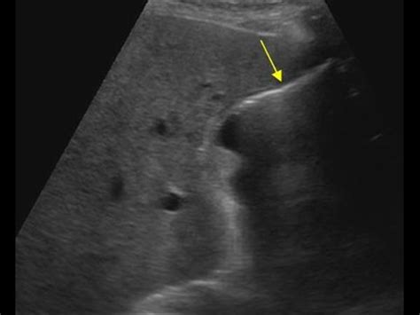 Abdomen And Retroperitoneum 1 2 Gallbladder And Bile Ducts Case 1 2