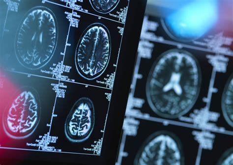 Understanding Spinal Muscular Atrophy Recent Clinical Insights Rare