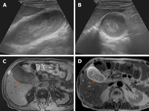 Gallbladder Sludge