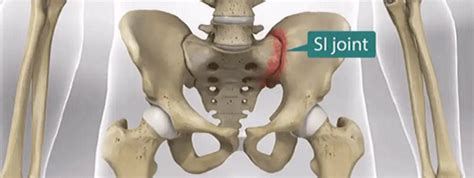 Sacroiliac Joint Dysfunction Si Joint Pain Lilyfield Physiotherapy