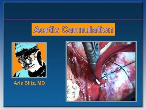 How To Cannulate The Aorta For Cardiopulmonary Bypass Arie Blitz Md