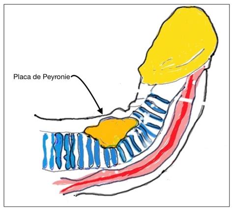 Doen A De Peyronie Dr Marcelo Thiel