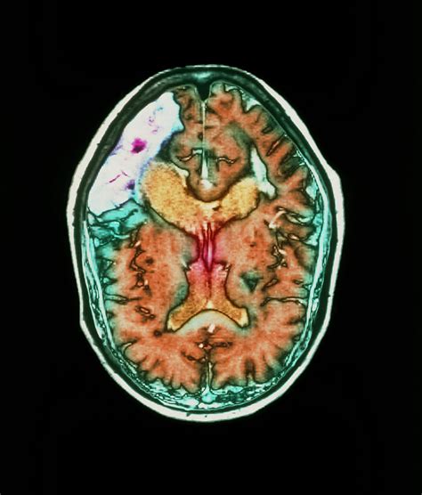 Mri Scan Of Brain Stroke Photograph By Simon Fraserroyal Victoria Infirmary Newcastle Upon