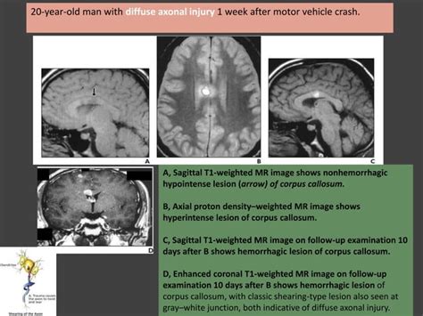 Disorders Of Corpus Callosum Ppt