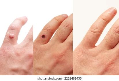 Laser Treatment Wart Removal Before After Stock Photo 2252481435